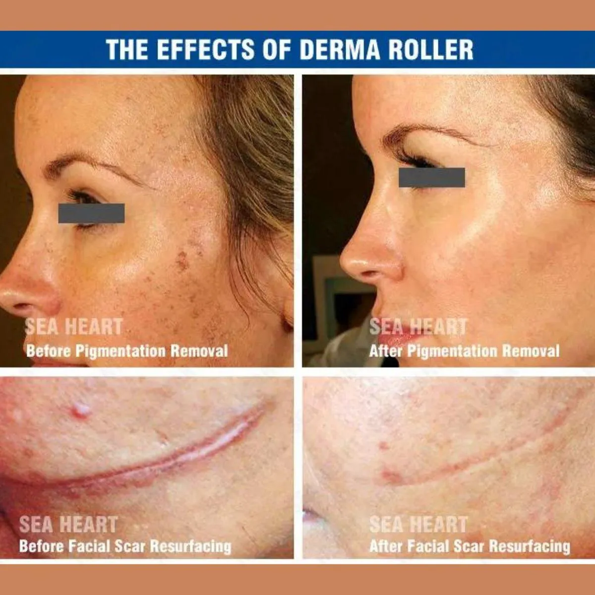 Derma Roller ZGTS